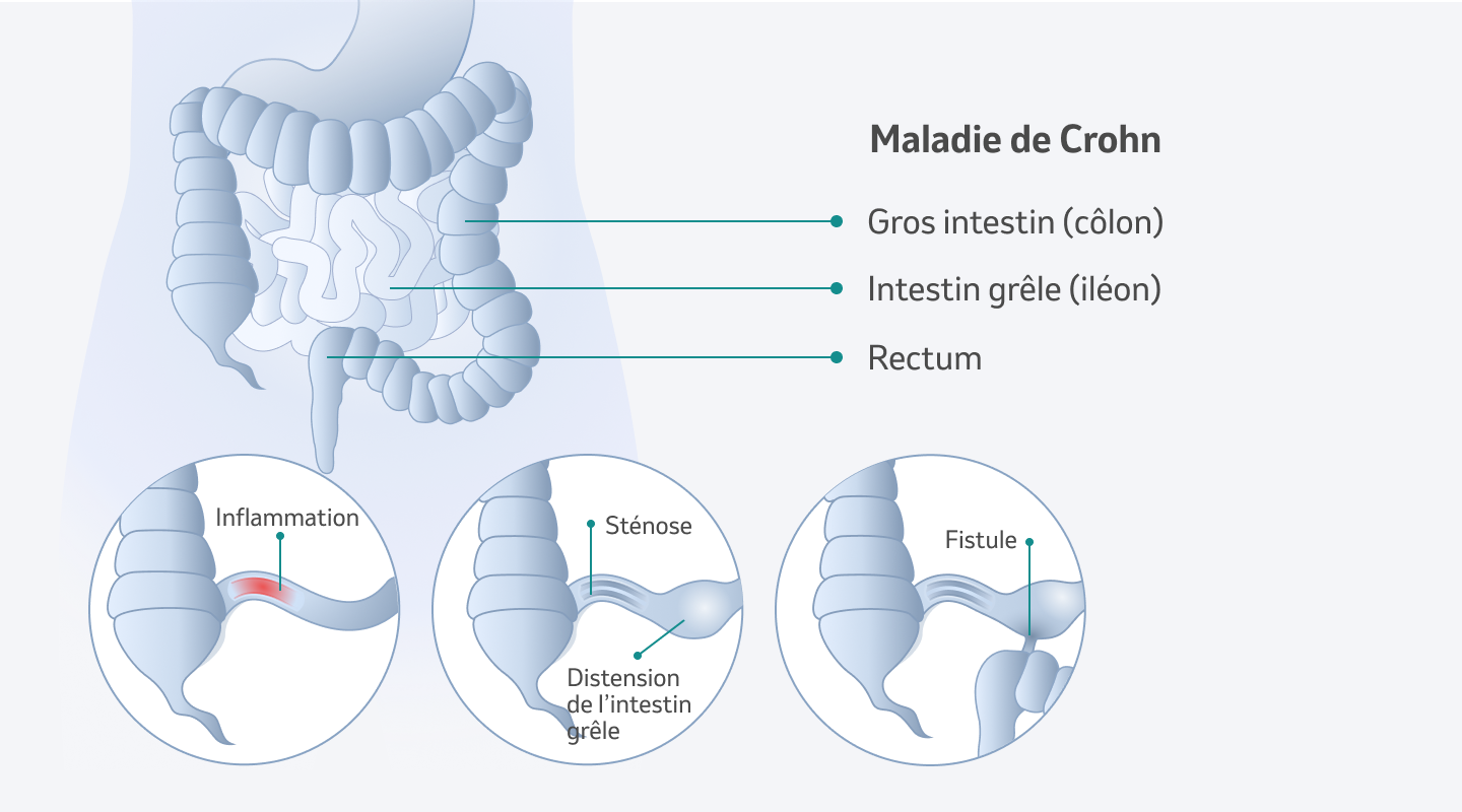 Maladie de Crohn - Definizione | MSD Salute Svizzera